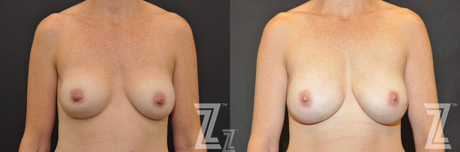 Austin Breast Reconstruction Before & After Gallery - Patient 132886773 - Image 1 - The Piazza Center