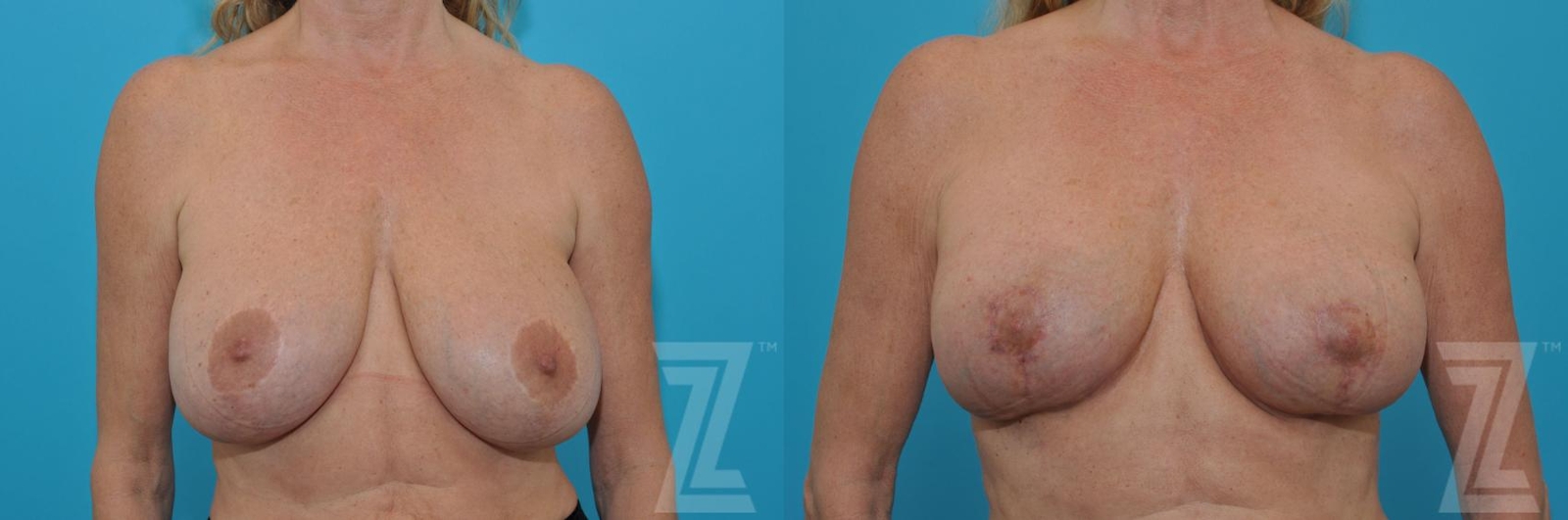 Austin Breast Augmentation Revision Before & After Gallery - Patient 132886579 - Image 1 - The Piazza Center