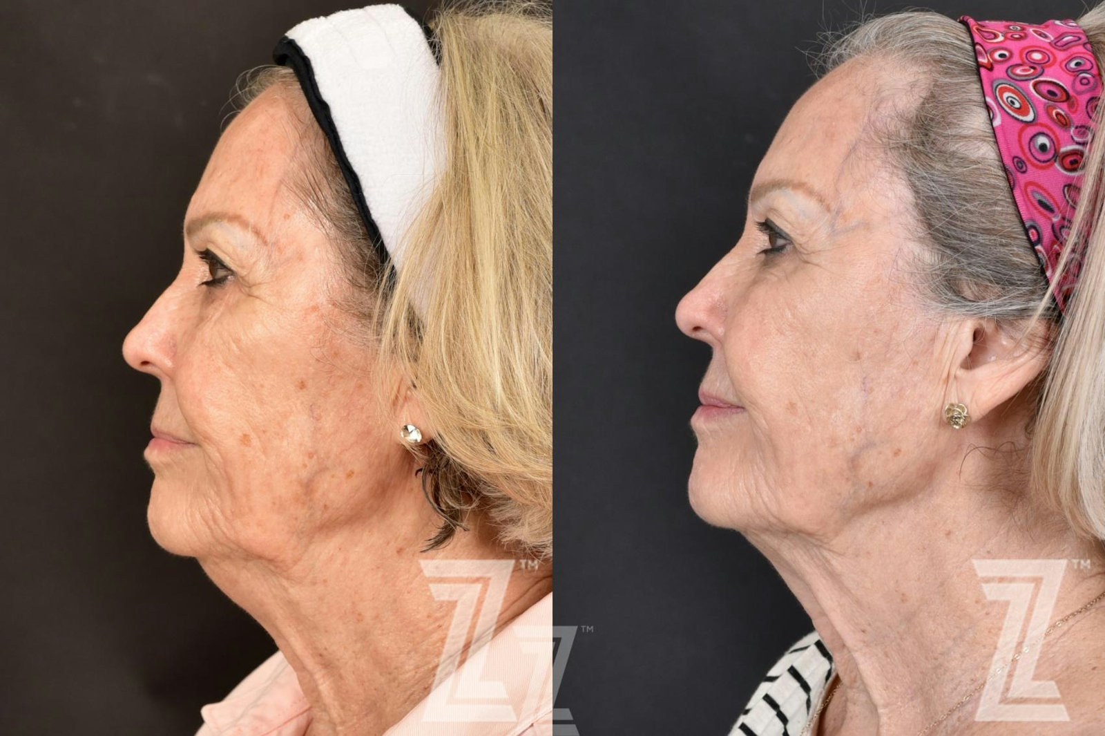Austin HALO Before & After Gallery - Patient 132963261 - Image 3 - The Piazza Center