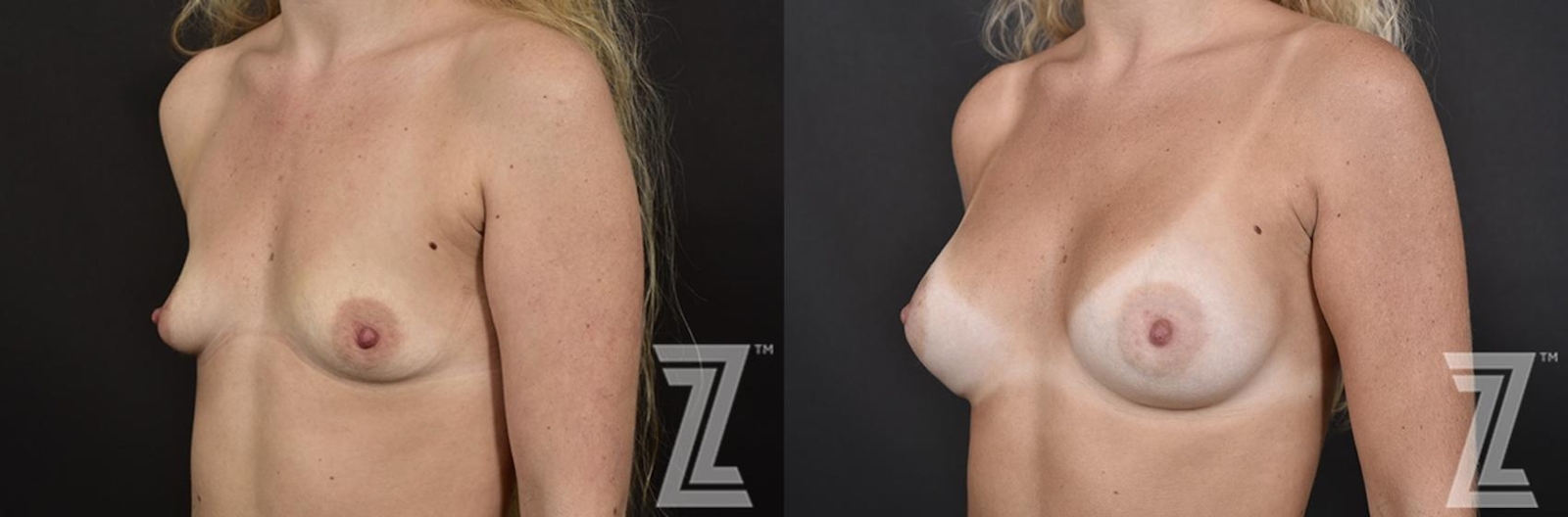 Austin Oblique view of before and after image of 23 year old woman with Silicone Implants with Cohesive Silicone Gel at the piazza center - The Piazza Center