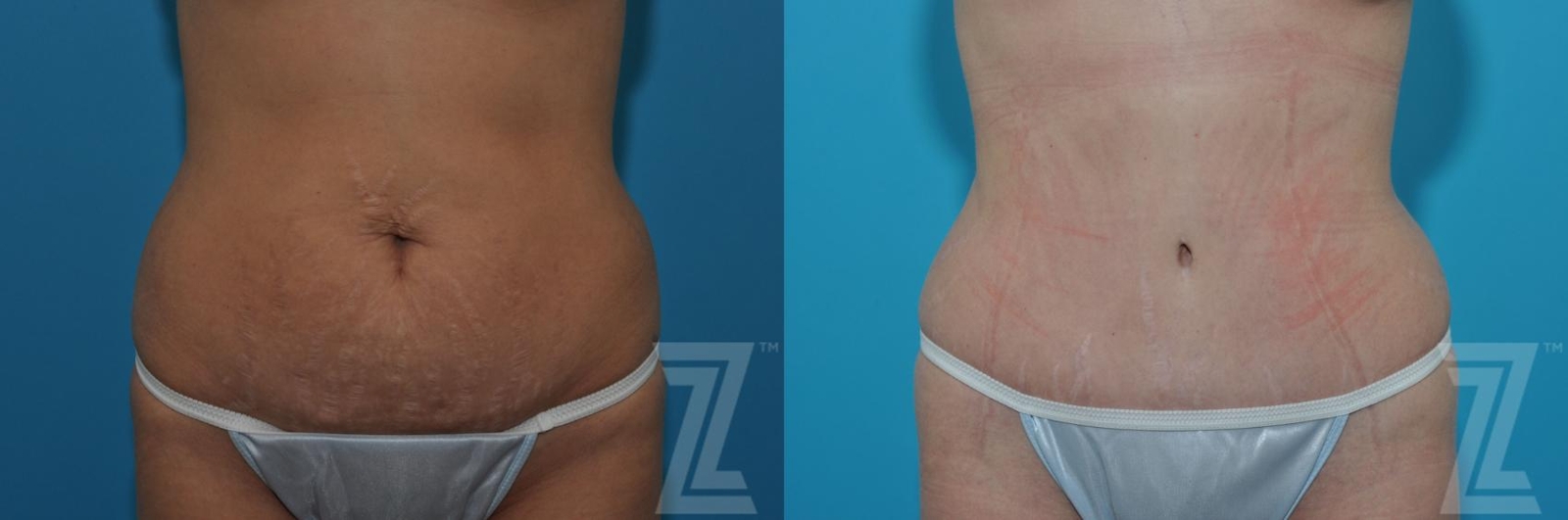 Austin Tummy Tuck Before & After Gallery - Patient 132886879 - Image 1 - The Piazza Center