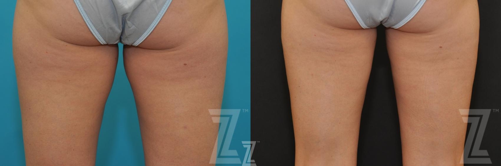 Austin CoolSculpting® Before & After Gallery - Patient 132905396 - Image 2 - The Piazza Center