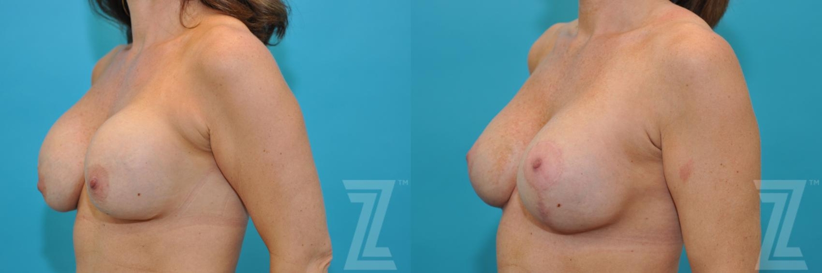 Austin Breast Augmentation Revision Before & After Gallery - Patient 132886575 - Image 2 - The Piazza Center