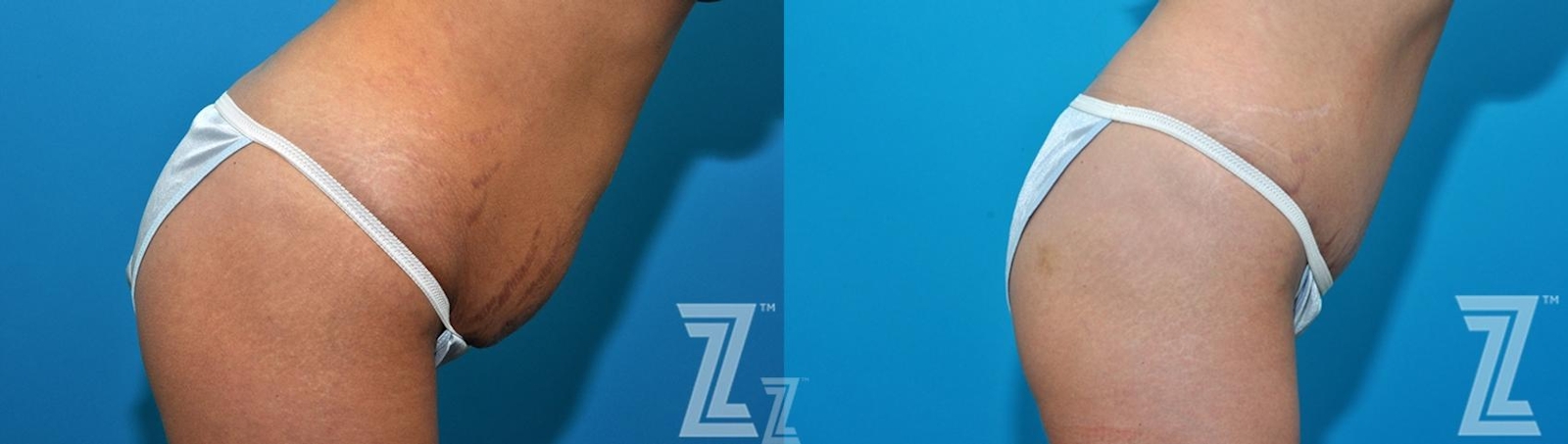 Austin Oblique flexion view before and after images 36 year old woman 1 year post op mommy makeover - Austin Tx, The Piazza Center - The Piazza Center