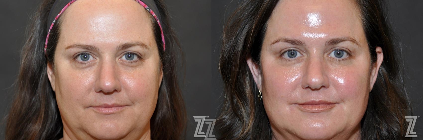 Austin Injectable Fillers Before & After Gallery - Patient 132906324 - Image 1 - The Piazza Center