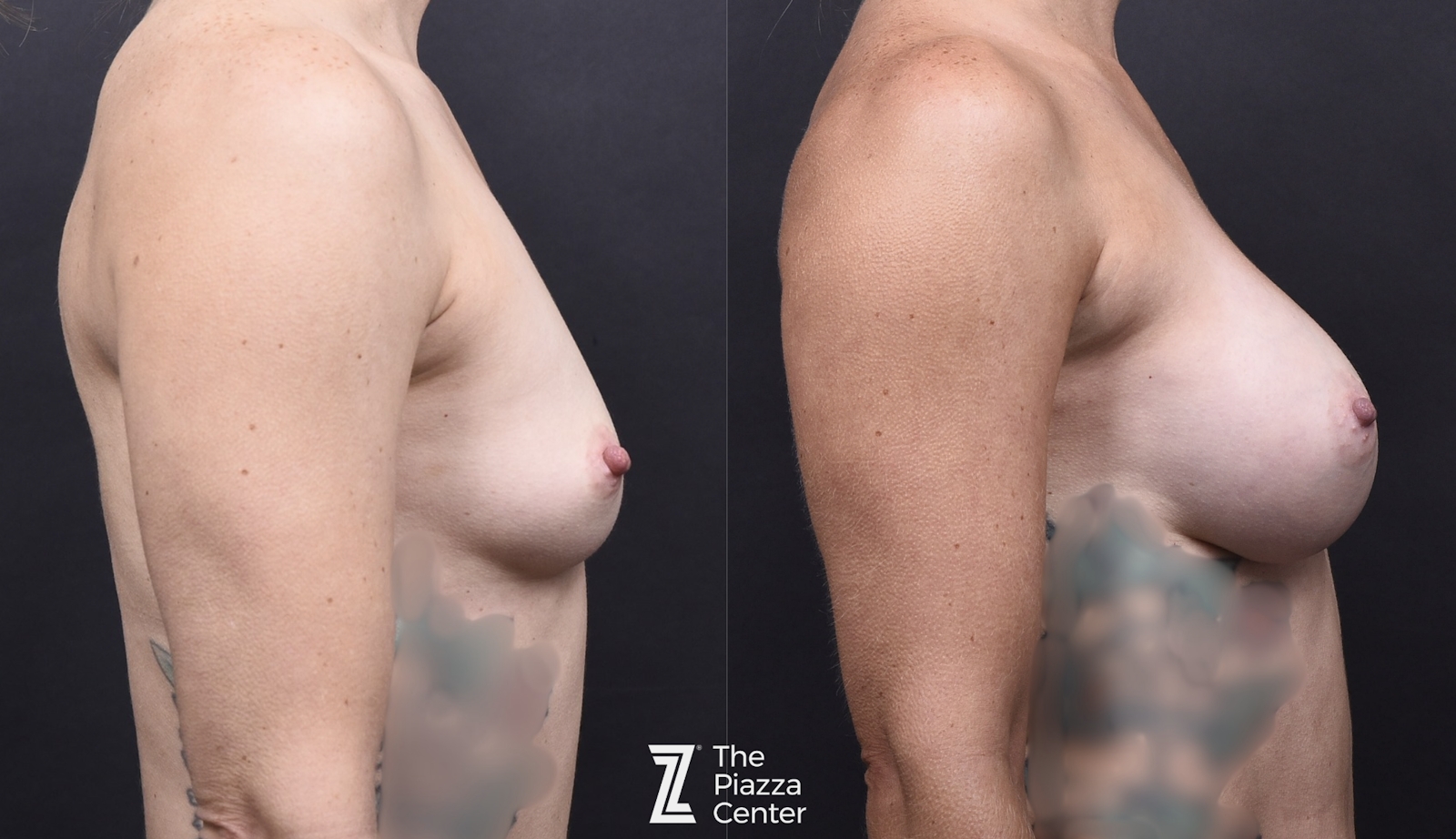 Austin Breast Augmentation Before & After Gallery - Patient 141191 - Image 3 - The Piazza Center