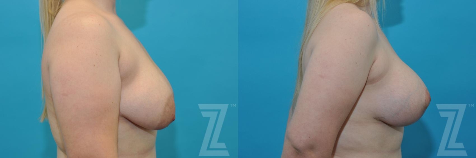Austin Correction of Breast Asymmetry Before & After Gallery - Patient 132886777 - Image 5 - The Piazza Center