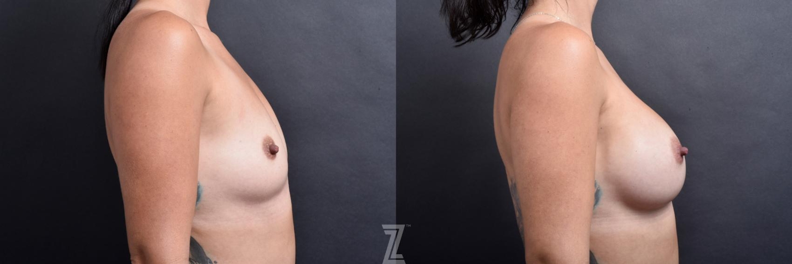 Austin Lateral view before and after image of 35 year old woman with Silicone Implants with Cohesive Silicone Gel - The Piazza Center - The Piazza Center