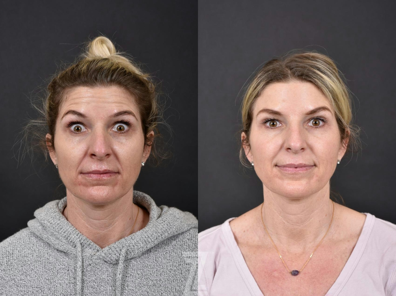 Austin Wrinkle Relaxers Before & After Gallery - Patient 132906304 - Image 2 - The Piazza Center