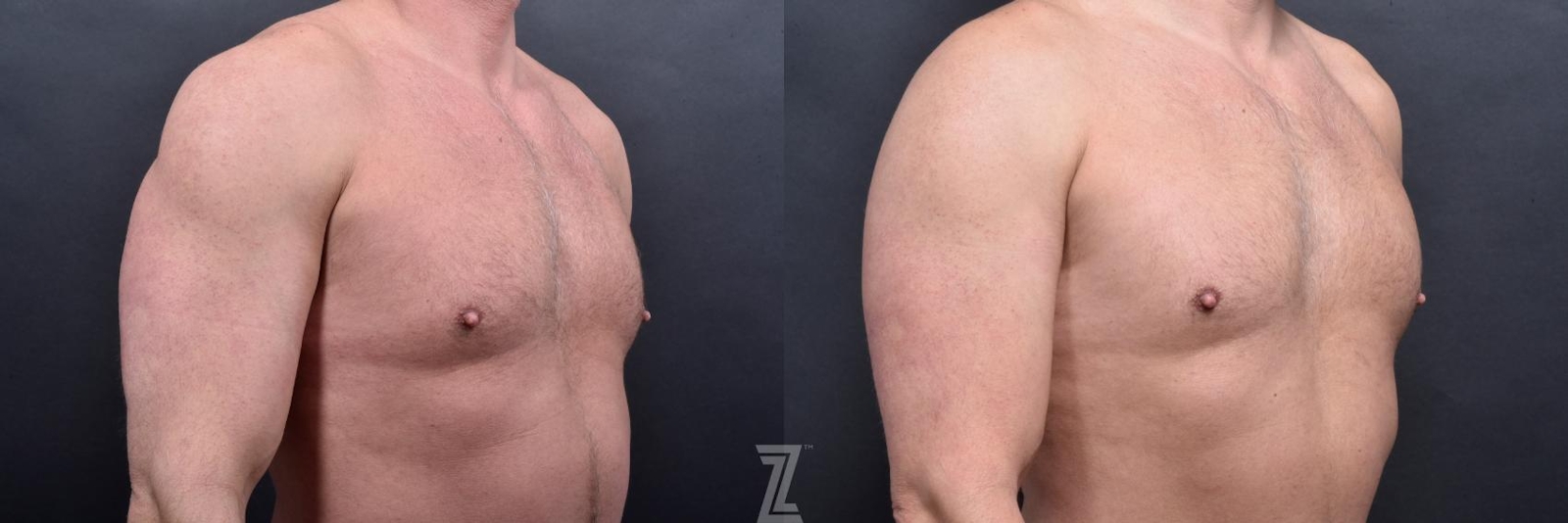 Austin Male Body Contouring Before & After Gallery - Patient 173307 - Image 6 - The Piazza Center