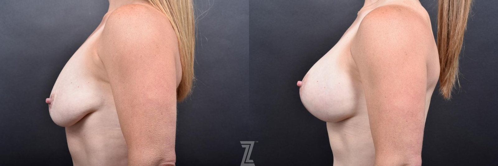 Austin Breast Augmentation With a Breast Lift Before & After Gallery - Patient 132791106 - Image 3 - The Piazza Center