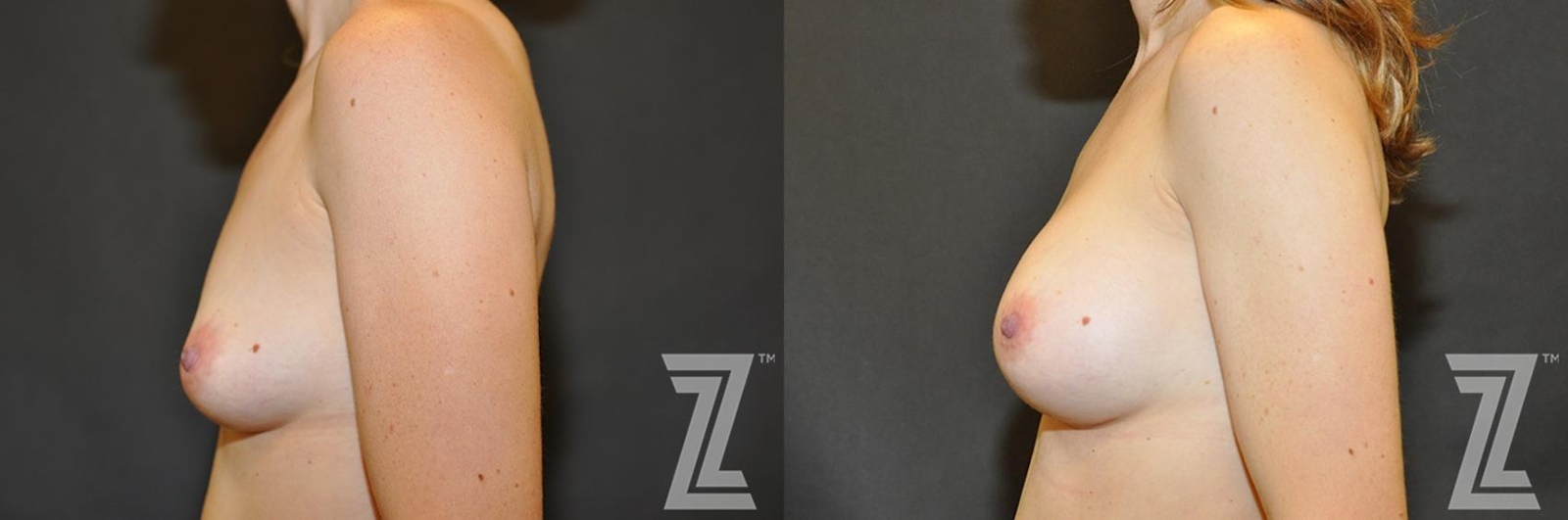 Austin Lateral view before & after of 34 year old woman with Silicone Implants with Cohesive Silicone Gel - The Piazza Center - The Piazza Center