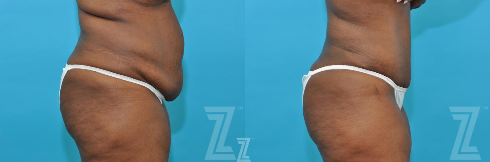 Austin Tummy Tuck Before & After Gallery - Patient 117774 - Image 4 - The Piazza Center