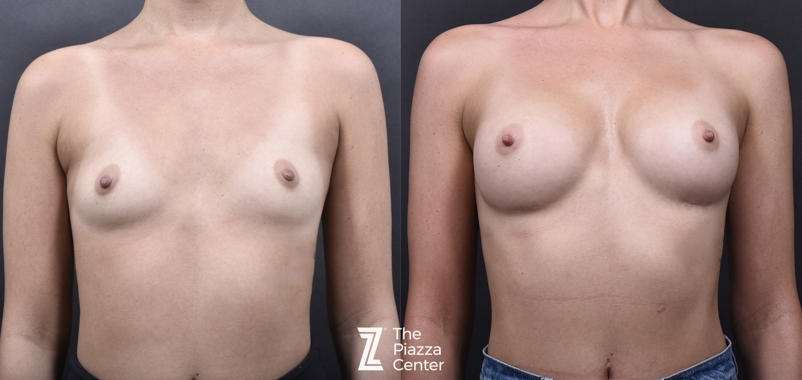 Austin Breast Augmentation Before & After Gallery - Patient 790705 - Image 1 - The Piazza Center