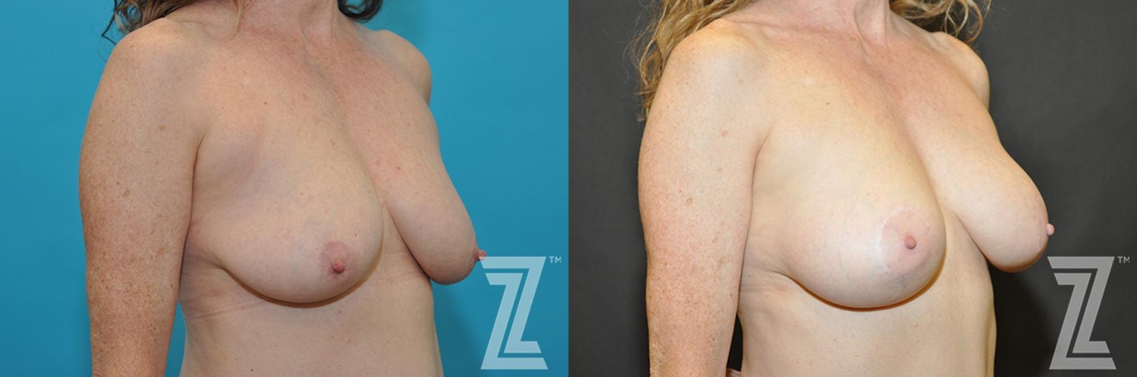 Austin Breast Augmentation With a Breast Lift Before & After Gallery - Patient 132791131 - Image 4 - The Piazza Center