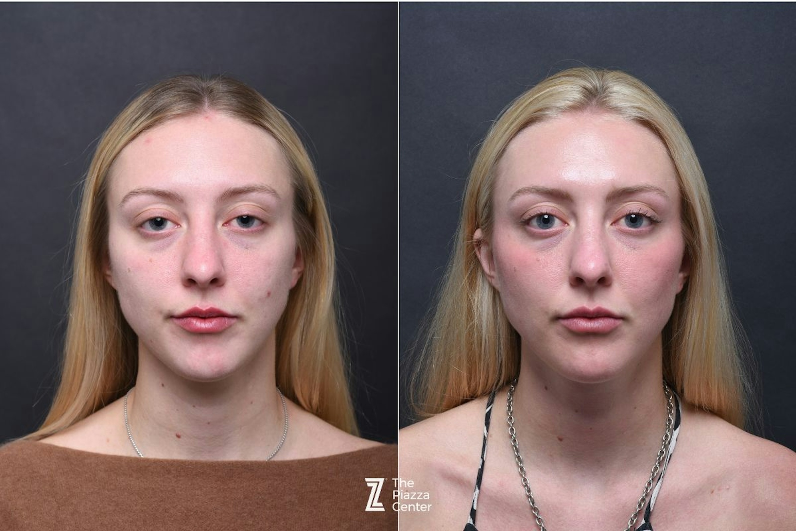 Austin Facial Rejuvenation Before & After Gallery - Patient 229953 - Image 1 - The Piazza Center