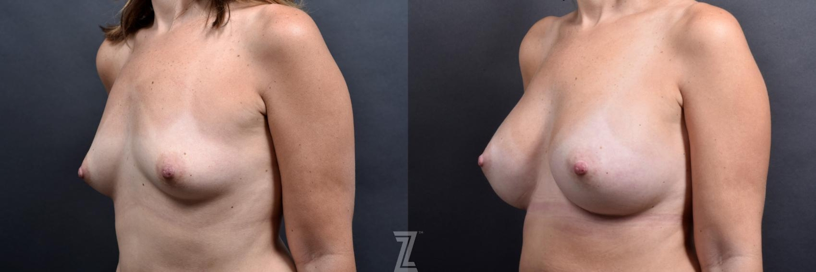 Austin oblique before and after images of 39 year old woman with Silicone Implants with Cohesive Silicone Gel - The Piazza Center - The Piazza Center
