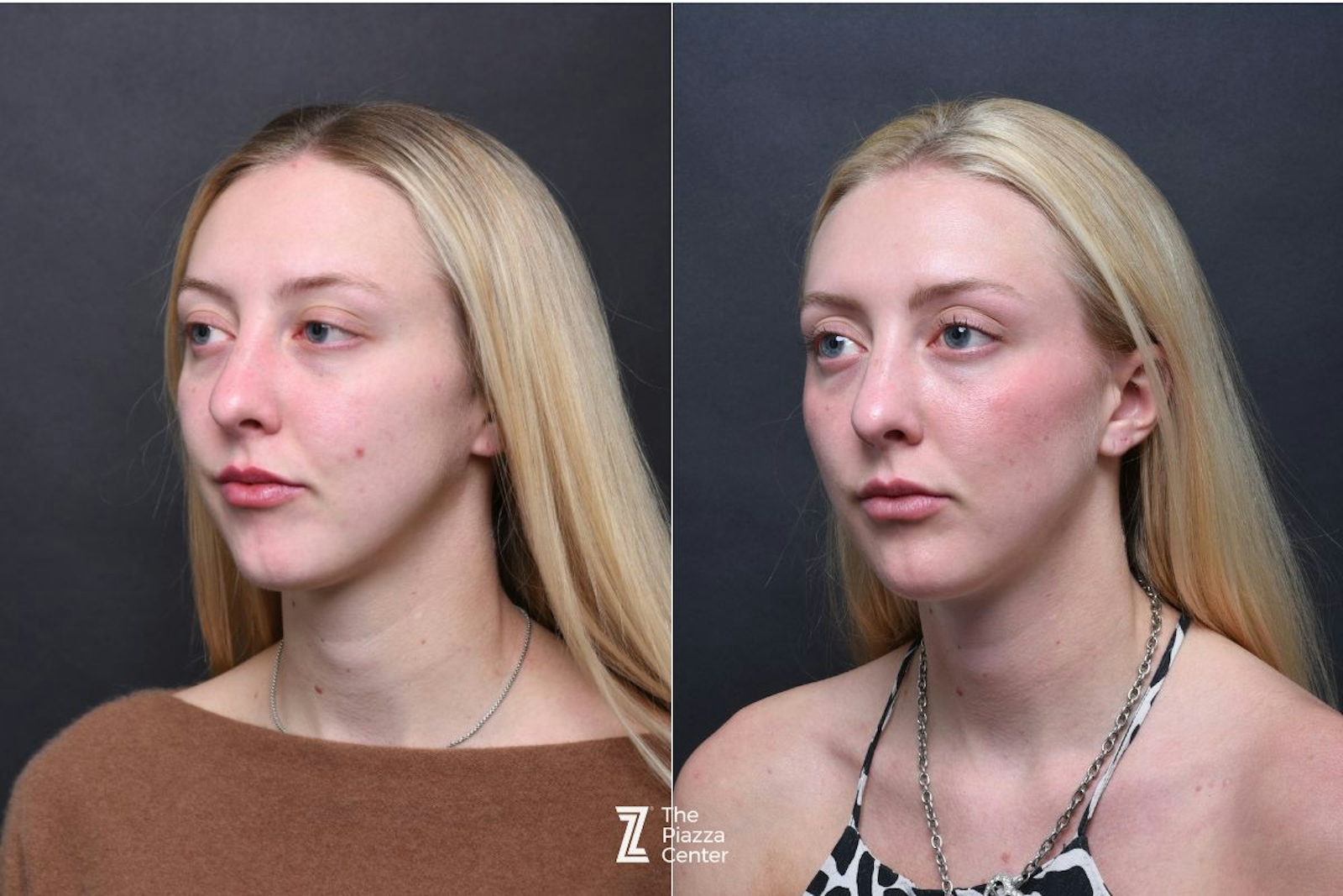 Austin Injectable Fillers Before & After Gallery - Patient 383581 - Image 2 - The Piazza Center