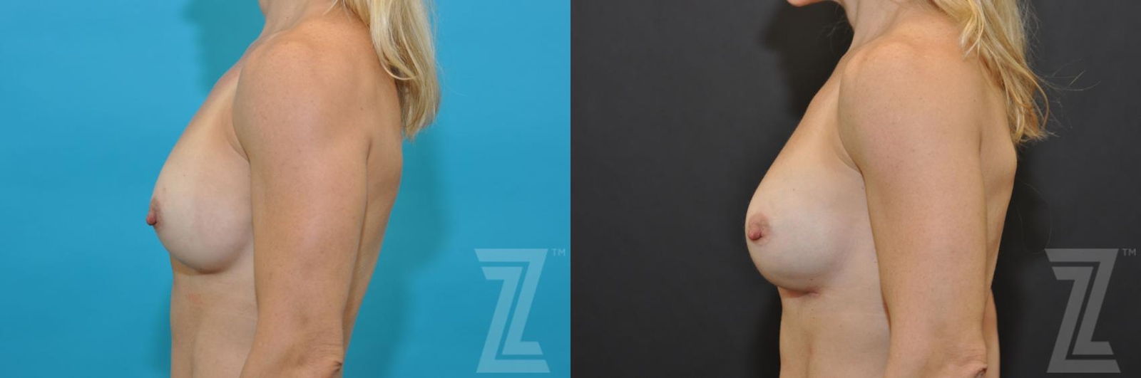 Austin Breast Augmentation Revision Before & After Gallery - Patient 132886580 - Image 3 - The Piazza Center