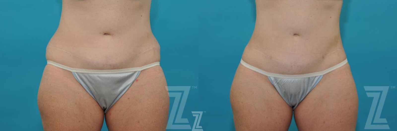 Austin Liposuction Before & After Gallery - Patient 132887304 - Image 1 - The Piazza Center