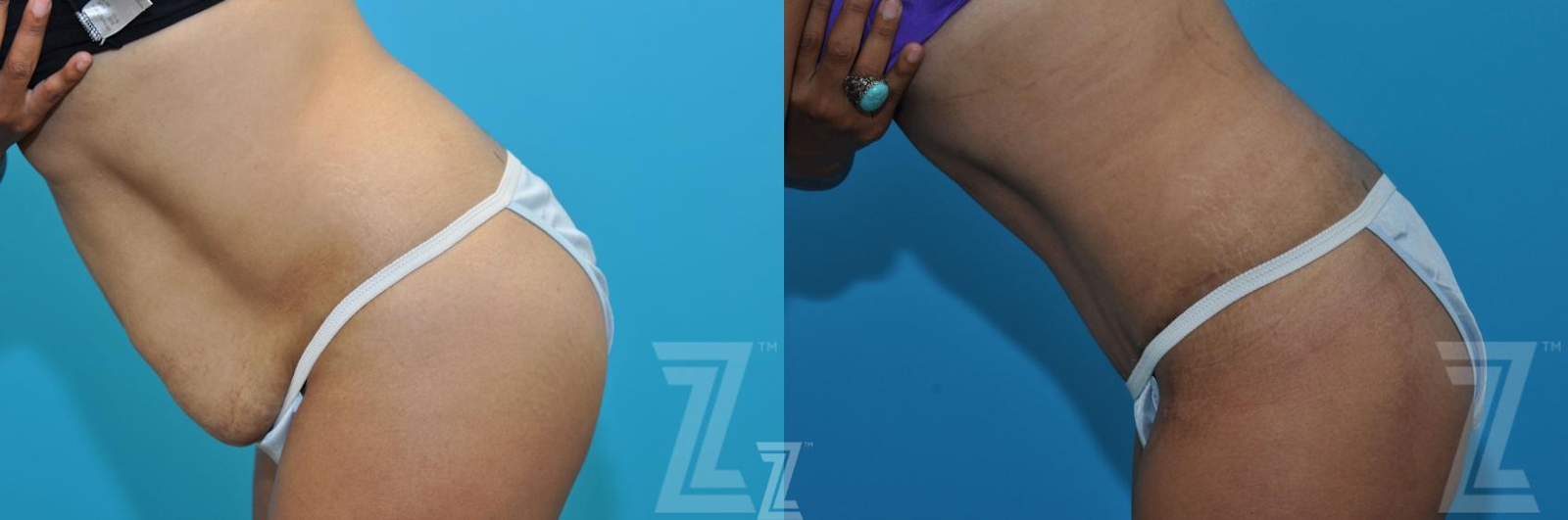 Austin Tummy Tuck Before & After Gallery - Patient 132886898 - Image 3 - The Piazza Center