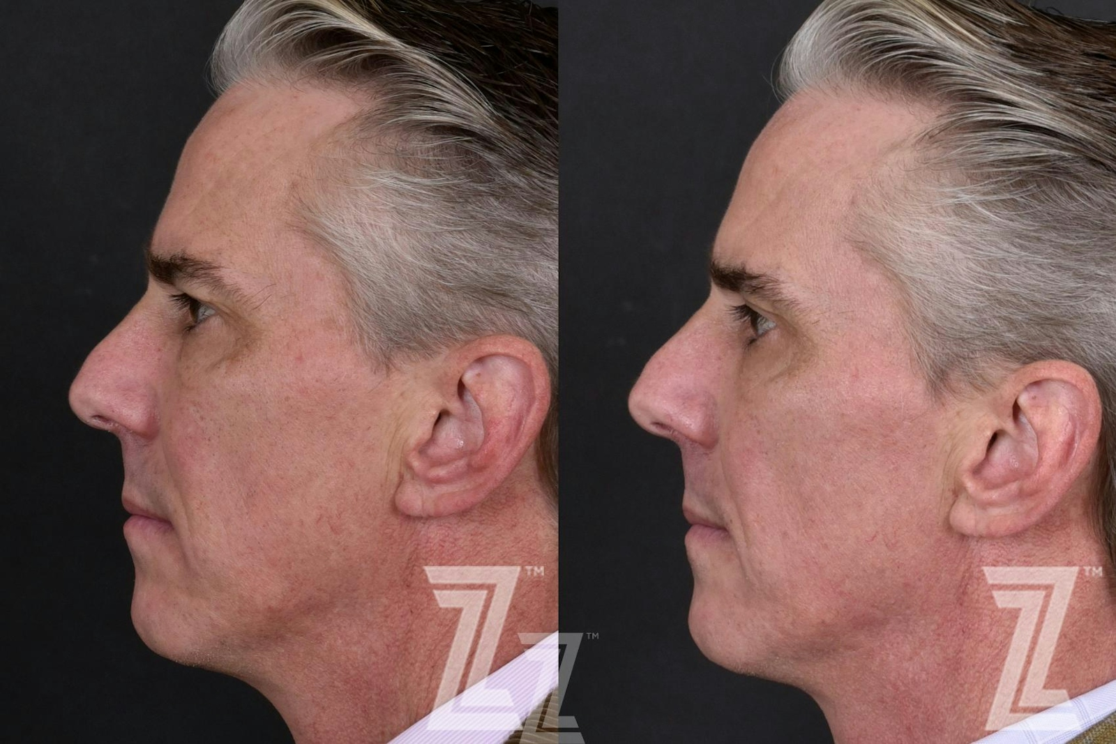 Austin Male Skin Treatments Before & After Gallery - Patient 336028 - Image 3 - The Piazza Center