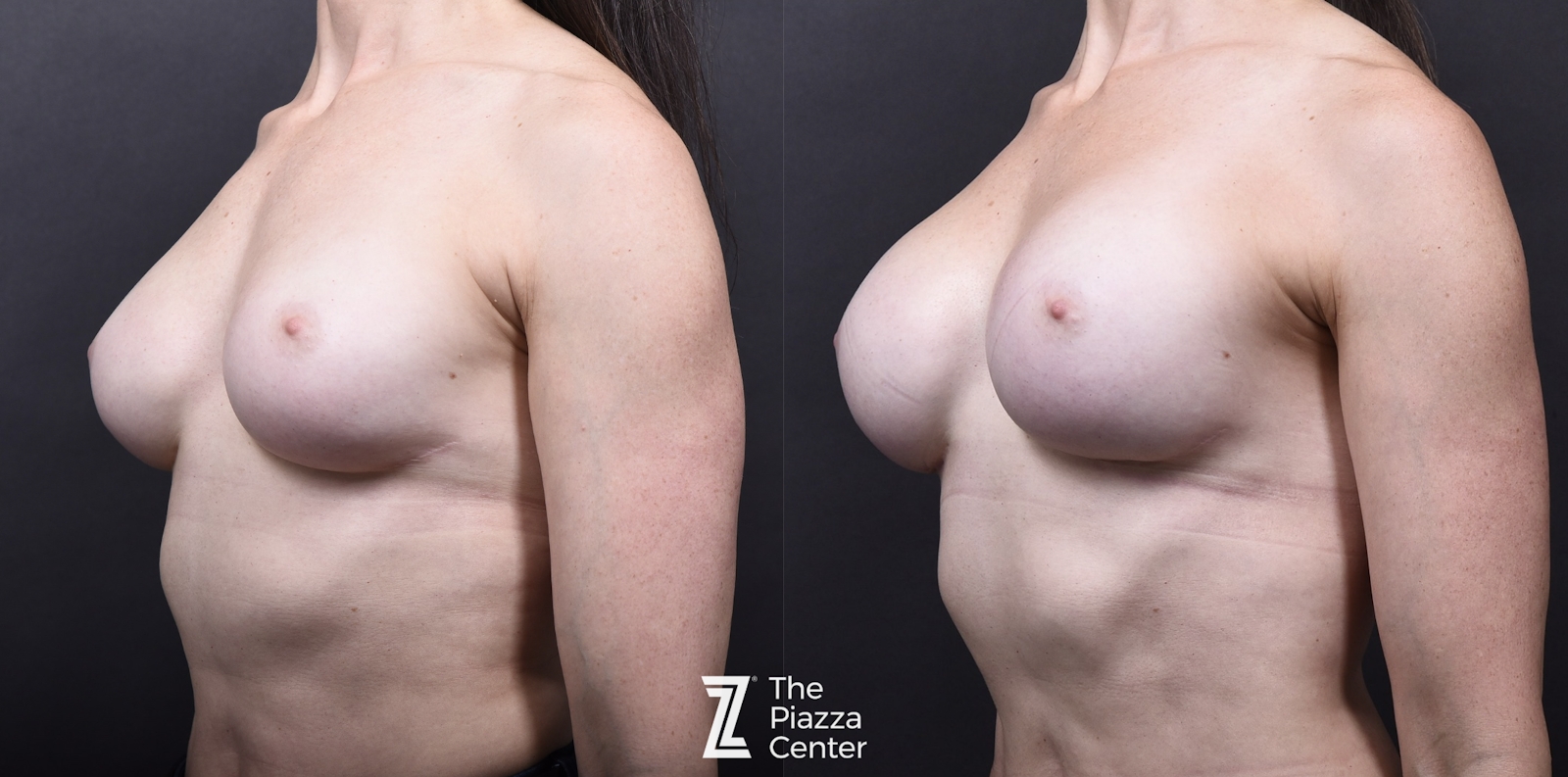 Austin Breast Augmentation Before & After Gallery - Patient 276383 - Image 2 - The Piazza Center