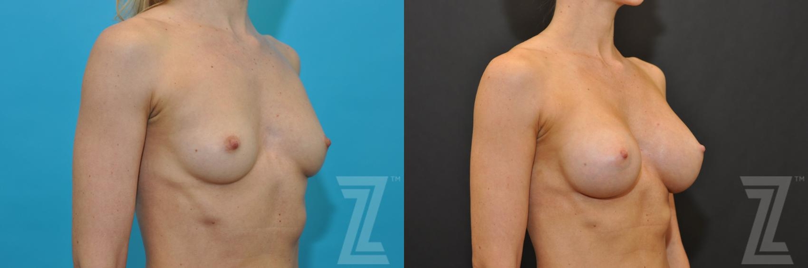 Austin Oblique View before and after of 36 year old woman with Silicone Implants with Highly Cohesive Gel (Gummy Bear Implants) - The Piazza Center - The Piazza Center