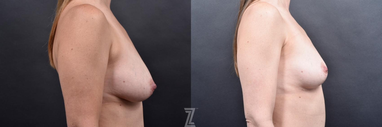 Austin Breast Reduction Before & After Gallery - Patient 606521 - Image 5 - The Piazza Center