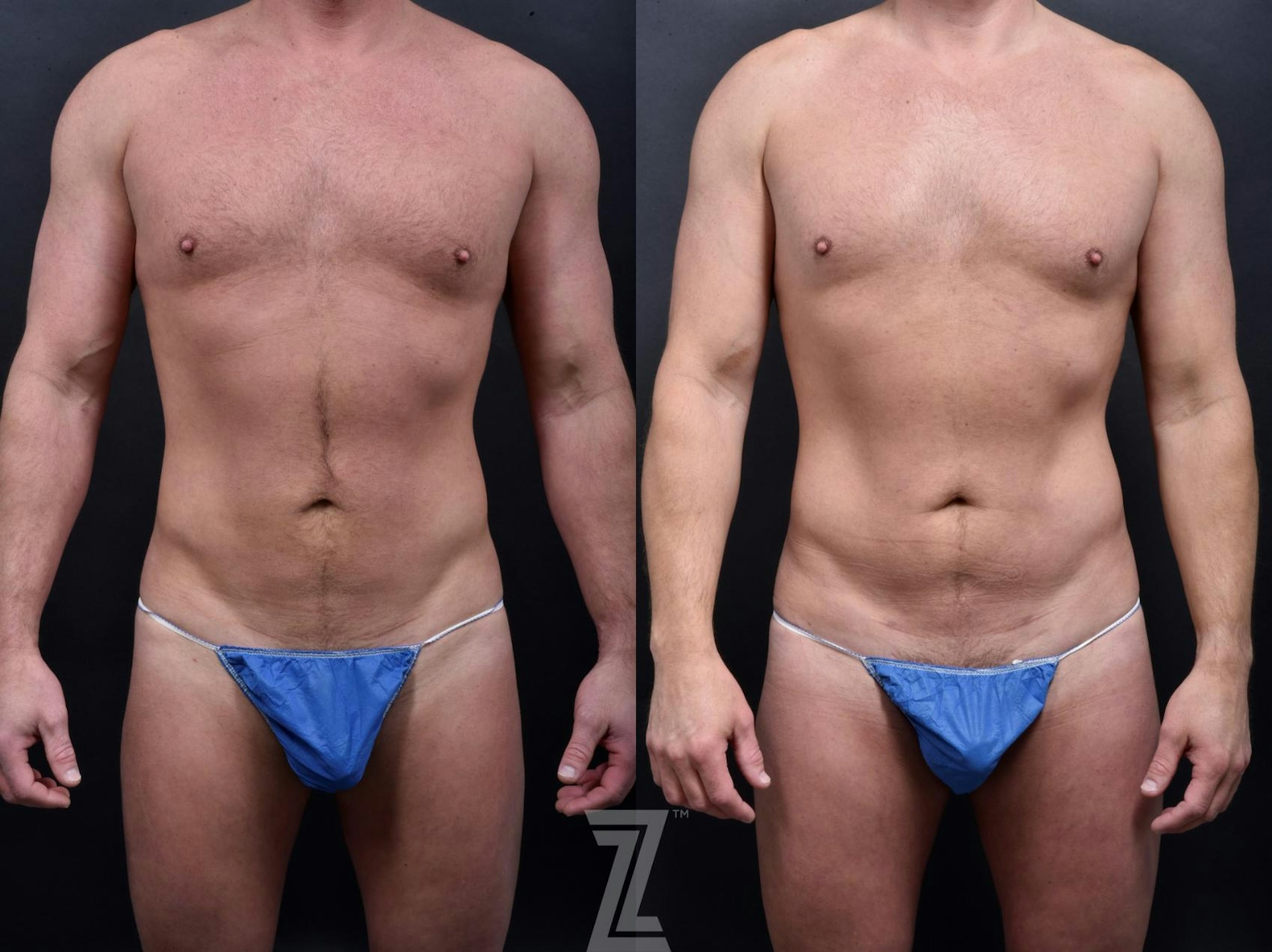 Austin Male Body Contouring Before & After Gallery - Patient 173307 - Image 1 - The Piazza Center