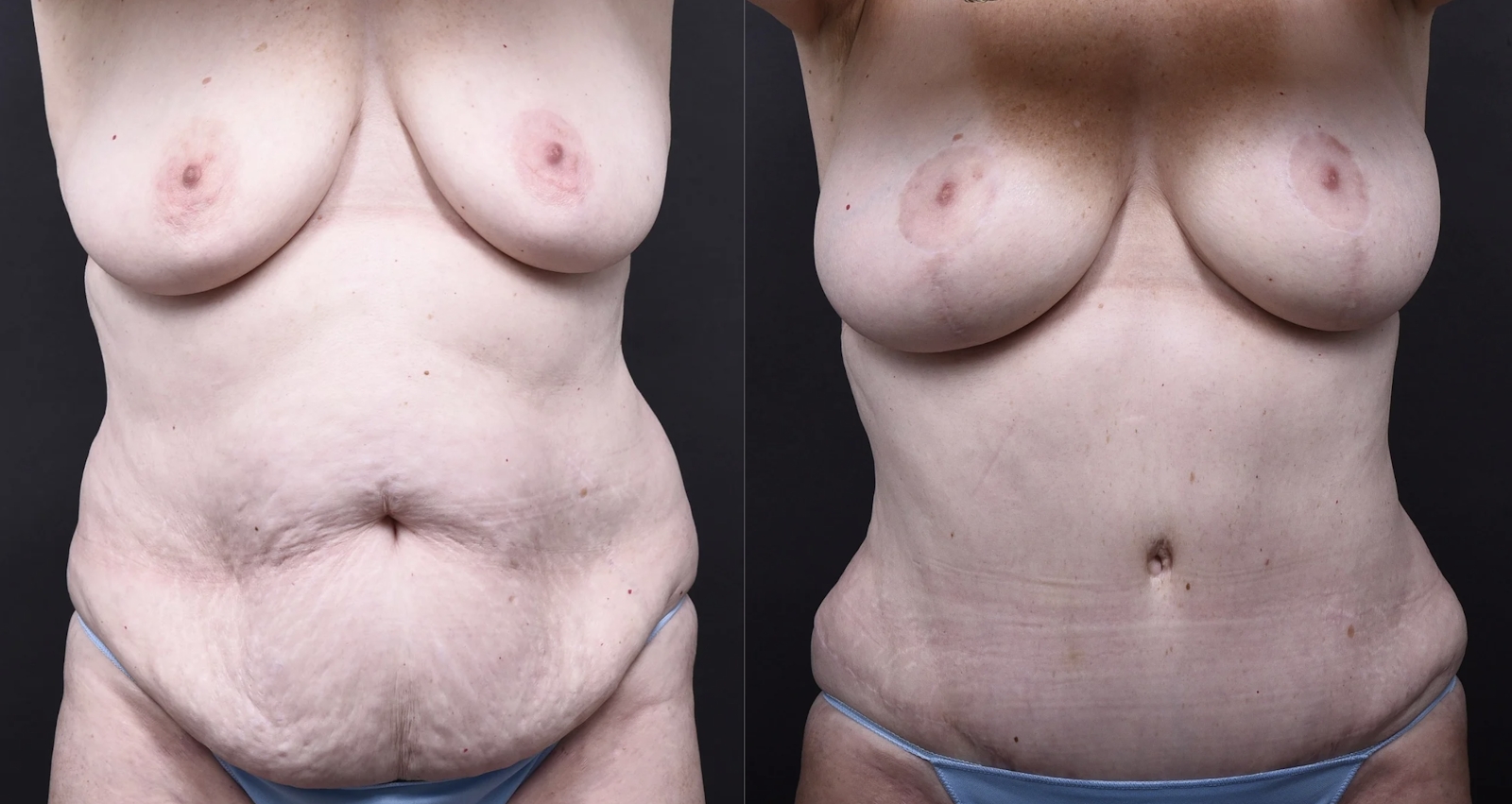 Austin Breast Augmentation With a Breast Lift Before & After Gallery - Patient 438571 - Image 6 - The Piazza Center