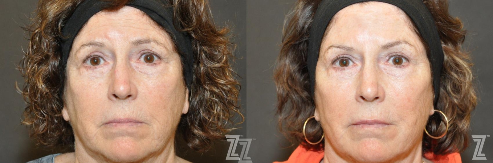 Austin Facial Rejuvenation Before & After Gallery - Patient 150326 - Image 1 - The Piazza Center