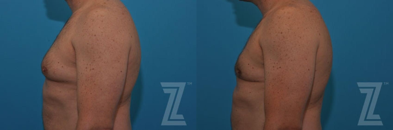 Austin Male Breast Reduction Before & After Gallery - Patient 132963592 - Image 2 - The Piazza Center