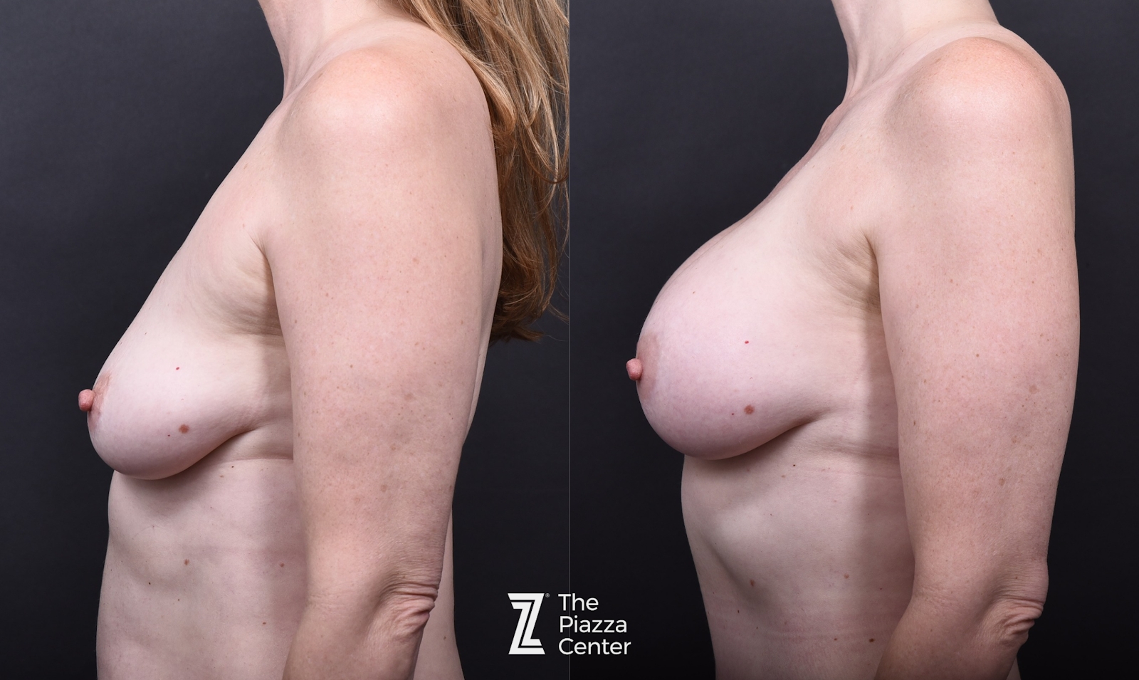 Austin Motiva Implants Before & After Gallery - Patient 390749 - Image 3 - The Piazza Center