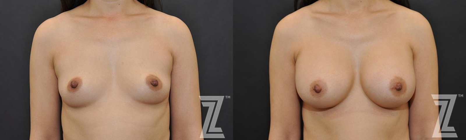 Austin Front view of Before & After image of woman with Silicone Implants with Highly Cohesive Gel (Gummy Bear Implants) - The Piazza Center