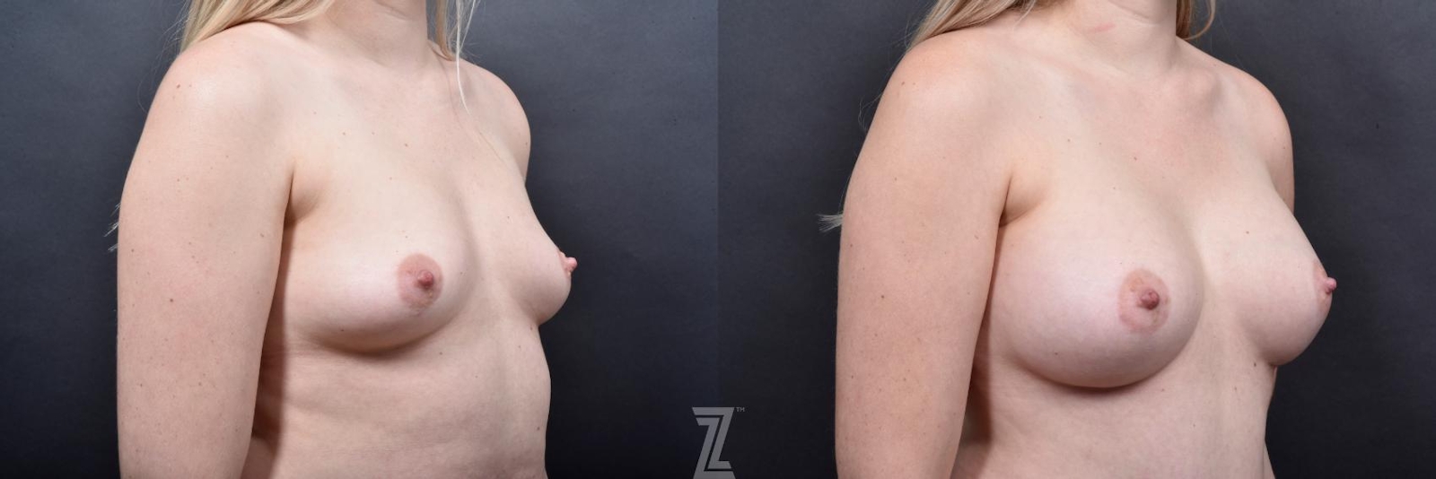 Austin Oblique View of Breast of 29-Year-Old Mommy Makeover Before & After by Dr. Rocco Piazza in Austin, Texas - The Piazza Center