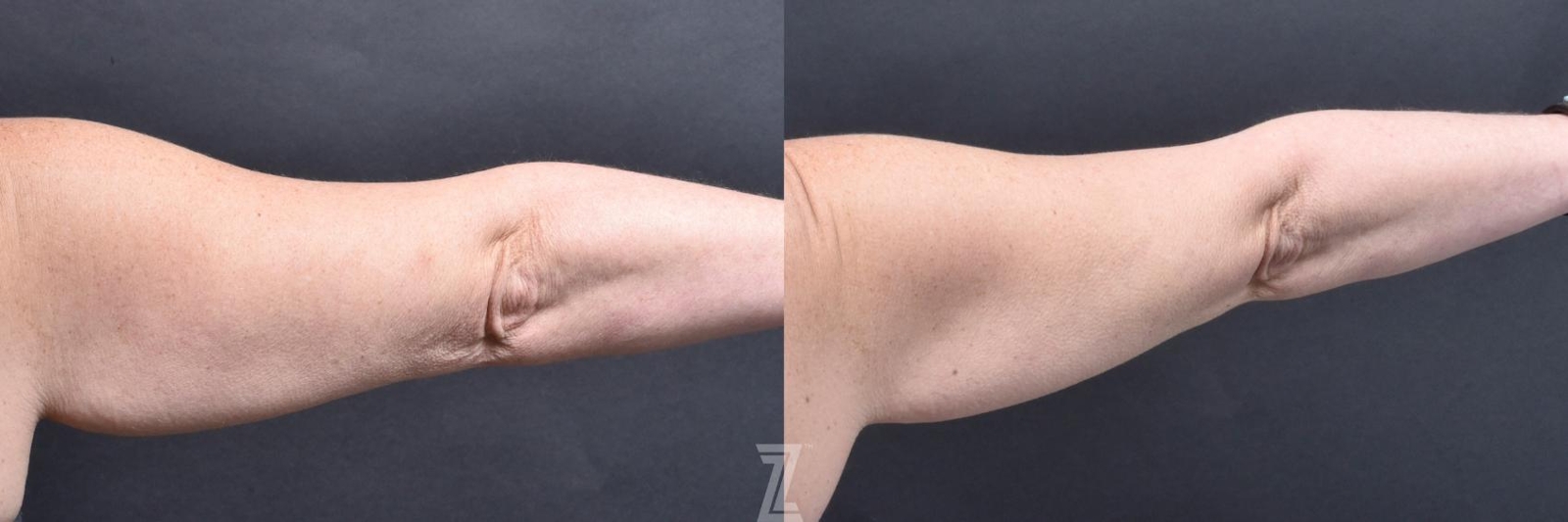Austin Profound® RF Microneedling Before & After Gallery - Patient 132963577 - Image 3 - The Piazza Center