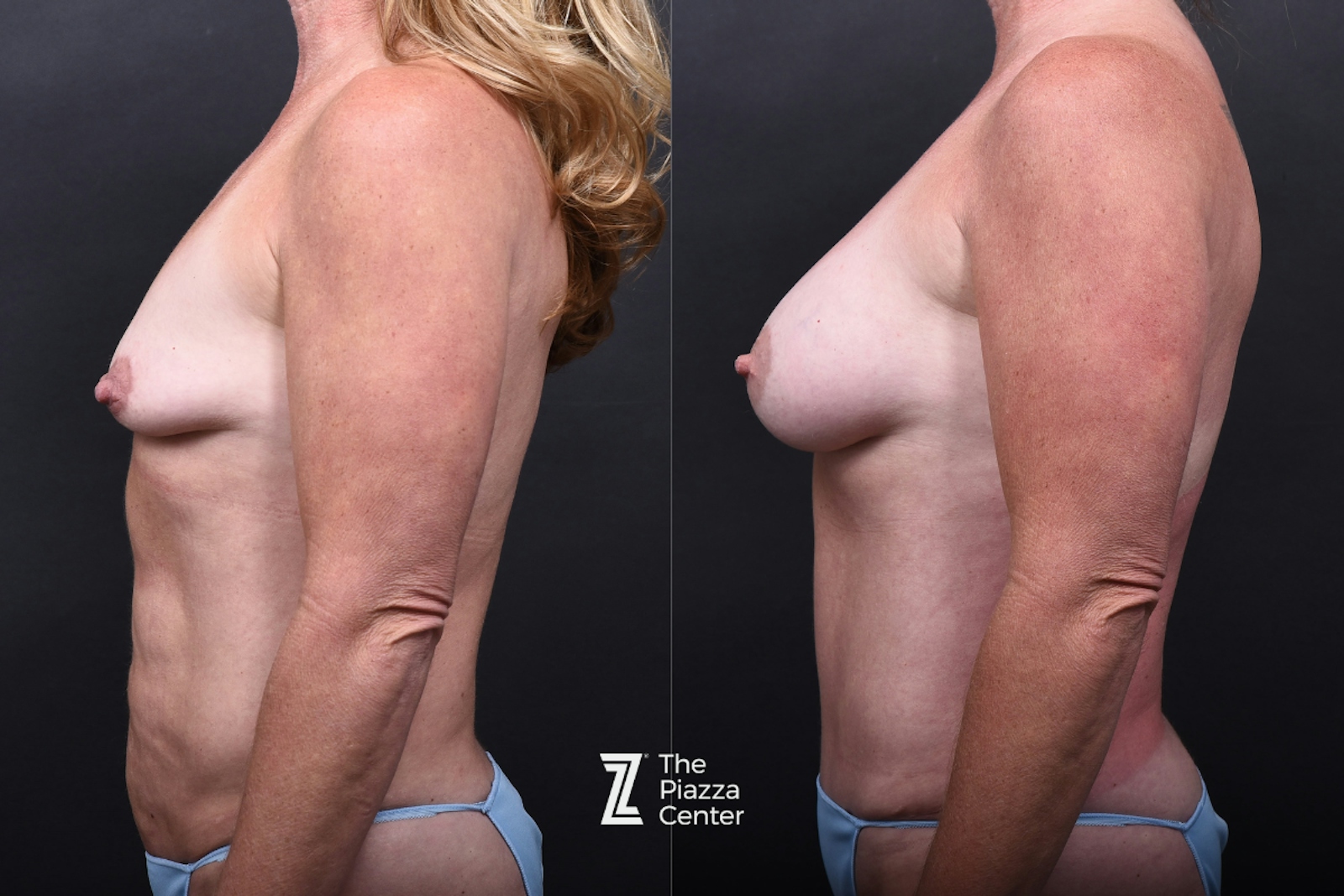 Austin Breast Augmentation Before & After Gallery - Patient 158035 - Image 5 - The Piazza Center