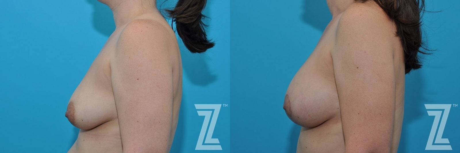 Austin Side breast view before & after 3 month post op 39 year old woman mommy make over - The Piazza Center, Austin TX - The Piazza Center