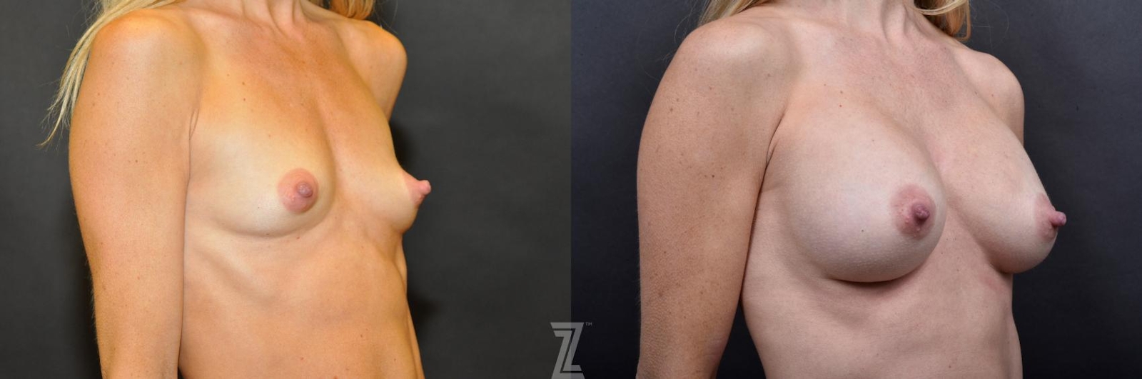 Austin Oblique View Before and After 4 year post op of 41 year old woman with Silicone Implants with Cohesive Silicone Gel - Dr. Rocco Piazza - The Piazza Center
