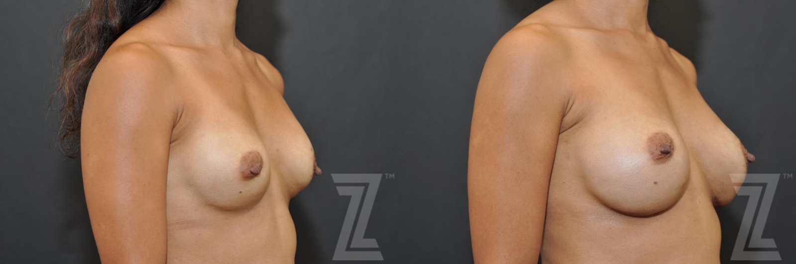 Austin Breast Augmentation Revision Before & After Gallery - Patient 132886551 - Image 4 - The Piazza Center