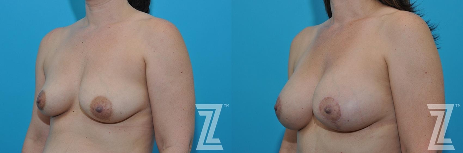 Austin Oblique breast view before & after 3 month post op 39 year old woman mommy make over - The Piazza Center, Austin TX - The Piazza Center