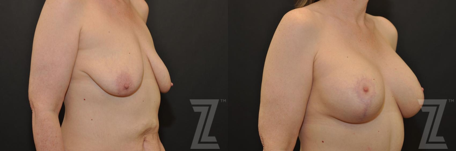 Austin Breast Augmentation With a Breast Lift Before & After Gallery - Patient 132793338 - Image 4 - The Piazza Center