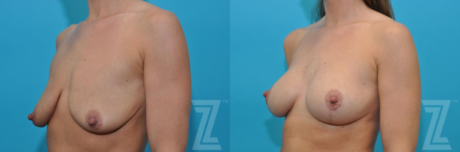 Austin Breast Augmentation With a Breast Lift Before & After Gallery - Patient 132791091 - Image 2 - The Piazza Center