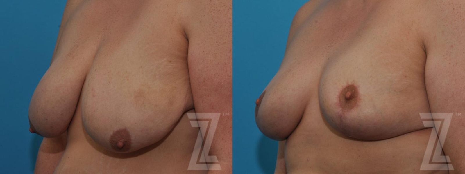 Austin Breast Reduction Before & After Gallery - Patient 132886599 - Image 2 - The Piazza Center