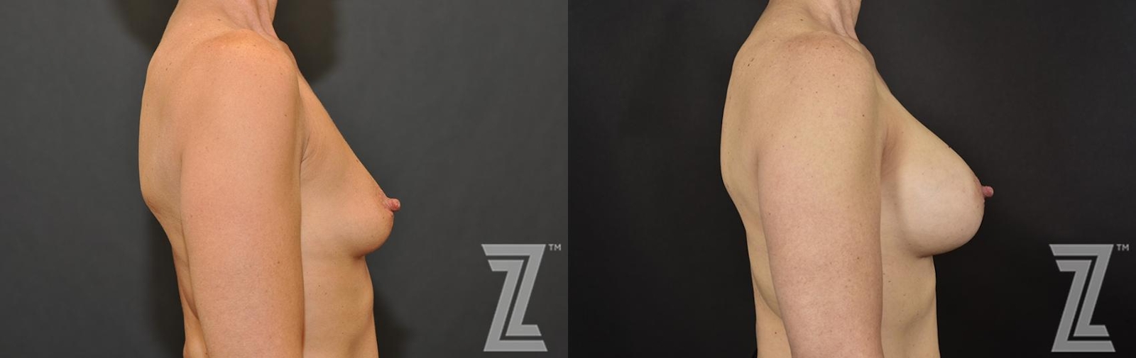 Austin 53 Year Old 3 year Post-OP Breast Augmentation Before & After in Austin, TX - The Piazza Center - side View - The Piazza Center