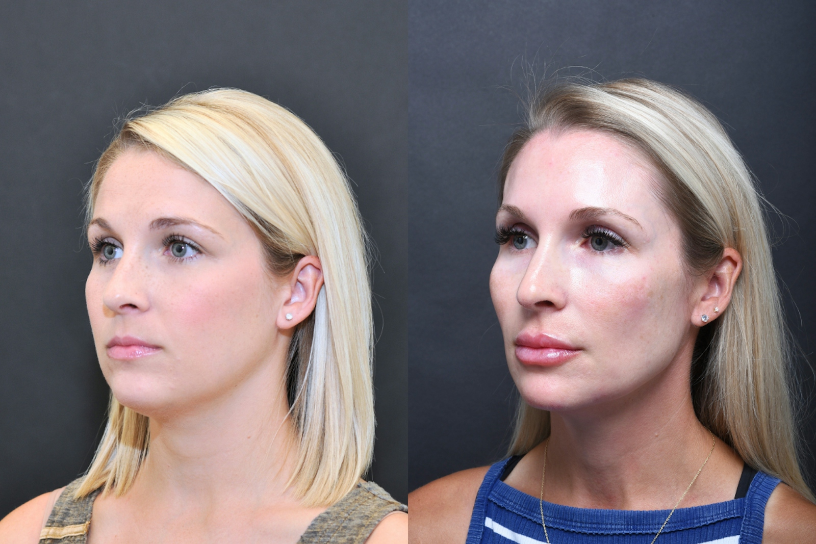 Austin Injectable Fillers Before & After Gallery - Patient 404245 - Image 2 - The Piazza Center