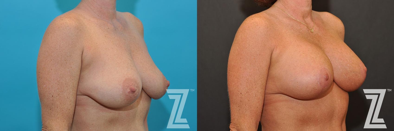 Austin Breast Augmentation With a Breast Lift Before & After Gallery - Patient 132791107 - Image 4 - The Piazza Center
