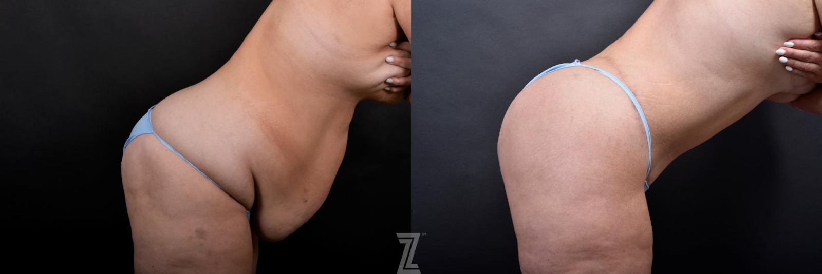 Austin Tummy Tuck Before & After Gallery - Patient 132886815 - Image 5 - The Piazza Center