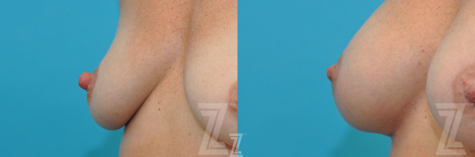 Austin Nipple Reduction Before & After Gallery - Patient 132886786 - Image 1 - The Piazza Center